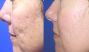 Procell-Acne-Scar